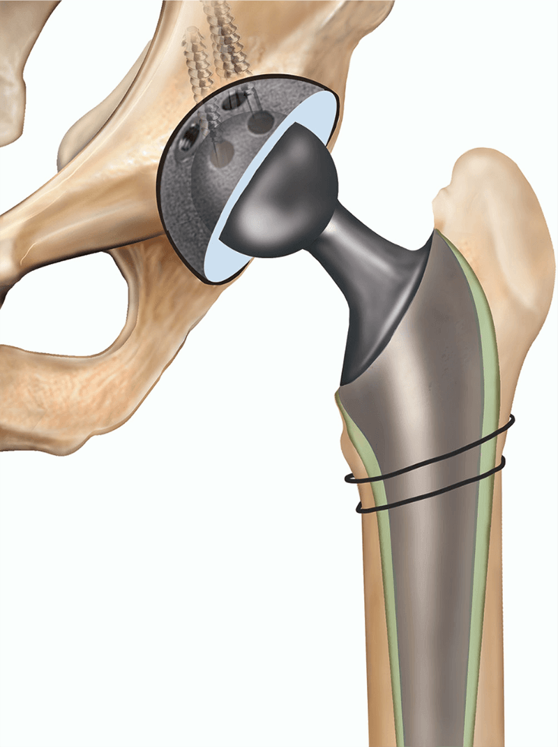 Implant Selection in Revision Total Hip Arthroplasty — chapter opening page
